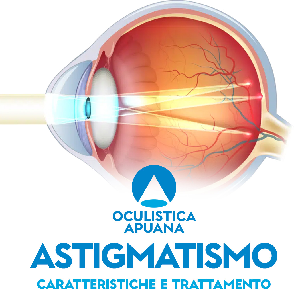 Astigmatismo: sintomi, cause, diagnosi e rimedi | Oculistica Apuana