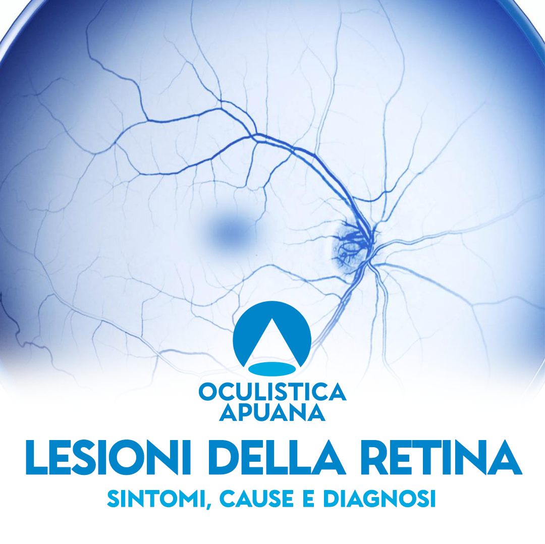 Lesioni della retina: sintomi, cause e diagnosi - Oculistica Apuana