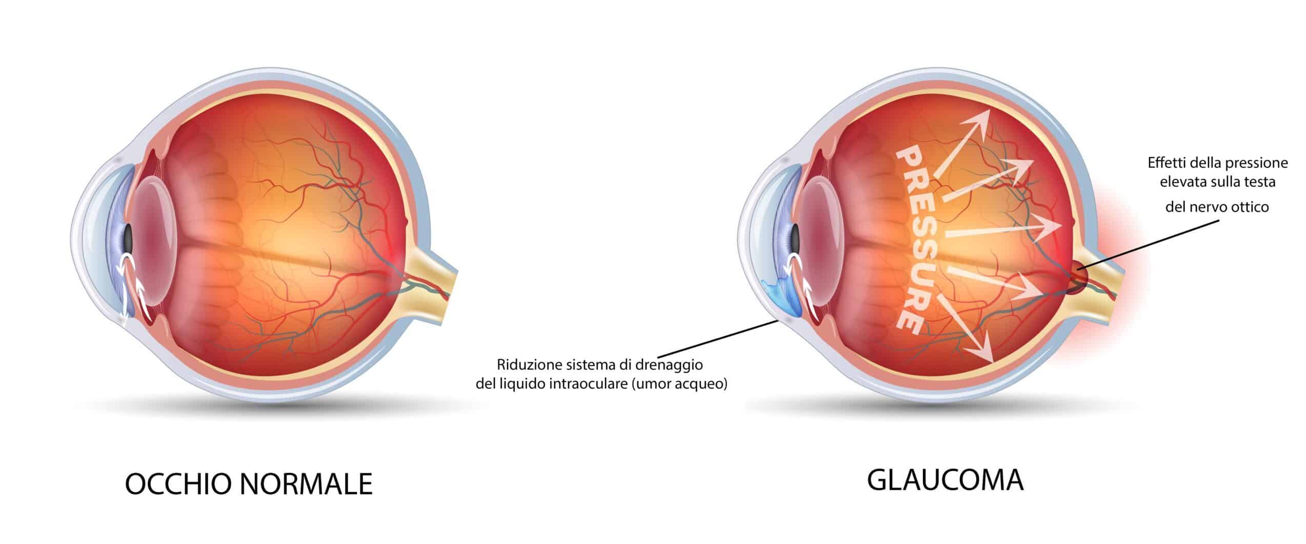 tonometria-pressione-intraoculare-glaucoma